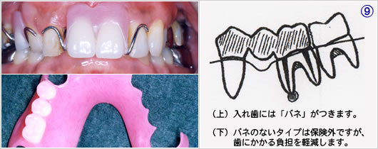（上）入れ歯には、バネがつきます。（下）バネの無いタイプは保険外ですが、歯にかかる負担を軽減します。