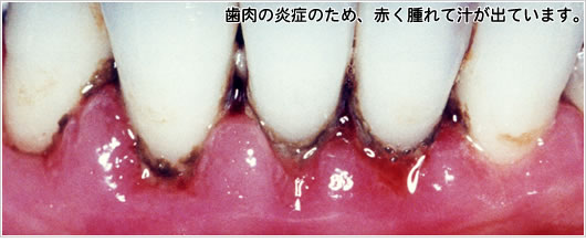 歯肉の炎症のため、赤く腫れて汁が出ています。