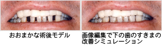 (左)おおまかな術後モデル、(右)画像編集で下の歯の隙間の改善シュミレーション